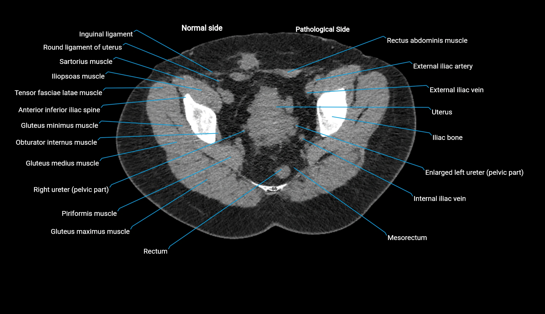CT KUB axial cross sectional anatomy  radiology image -img-00201-00147.webp